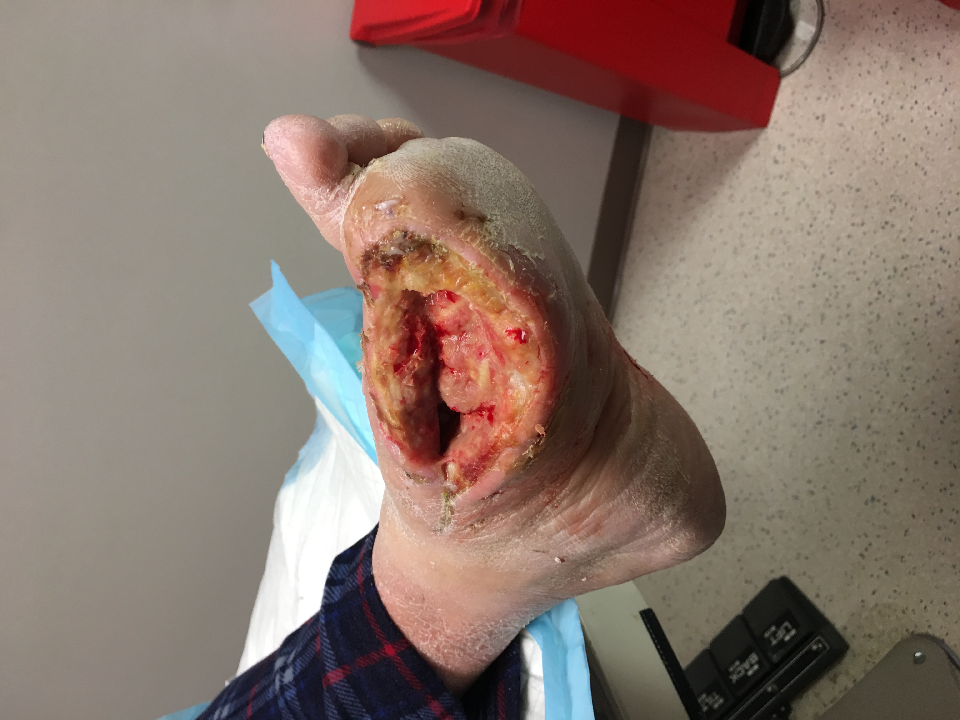 Surgical wound initial presentation